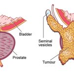 Prostate Cancer05