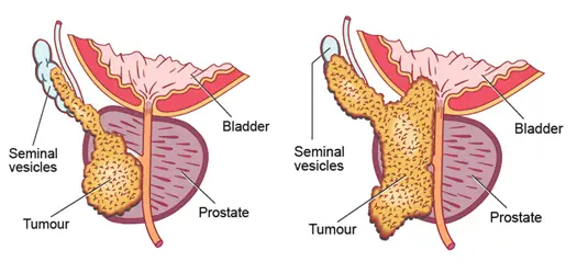 Prostate Cancer05