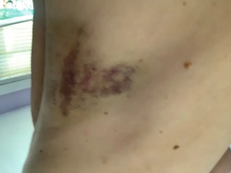 A Picture of Jody Elliott’s Body Showing a Massive Bruise Near the Small of Her Back