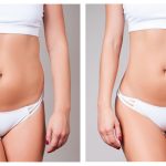 laser-stomach-coolsculpting-773024302