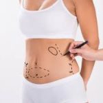 liposuction Surgery