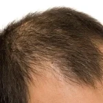 male baldness