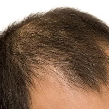 male baldness