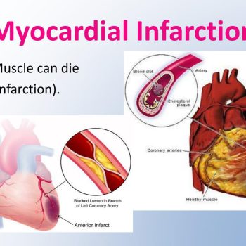 myocardial-infarction-l