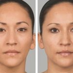 Sculptra Fillers in Saudi Arabia