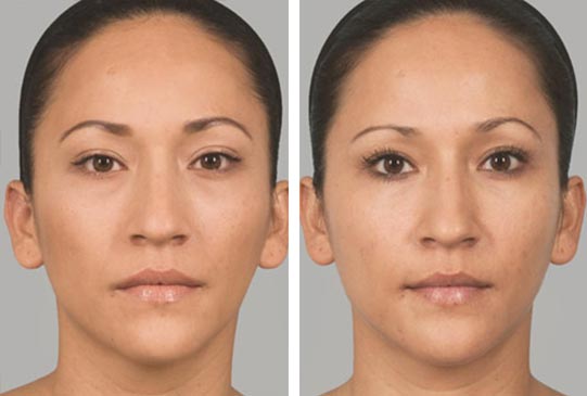 Sculptra Fillers in Saudi Arabia