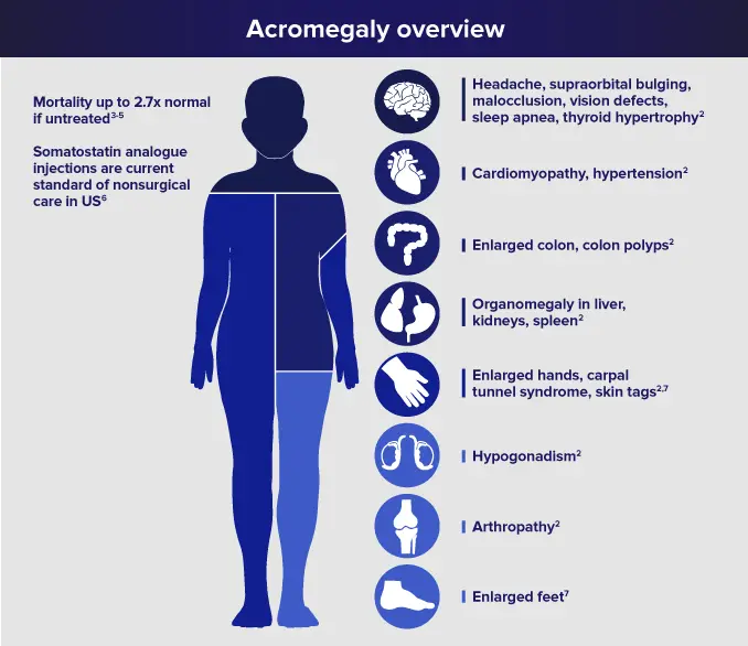 Acromegaly Disease...