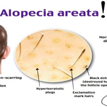 Alopecia-Areata-Causes