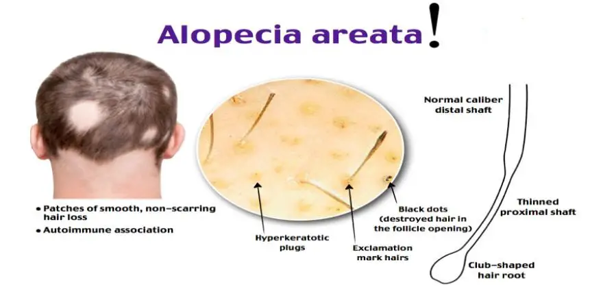 Alopecia-Areata-Causes