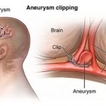 Brain Aneurysms 01