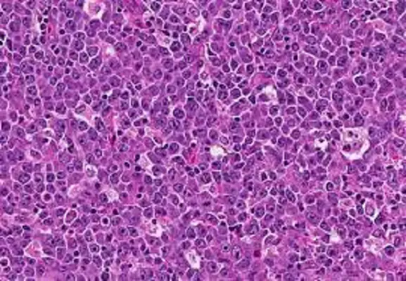 Diffuse Large B-Cell Lymphoma (DLBCL) Market