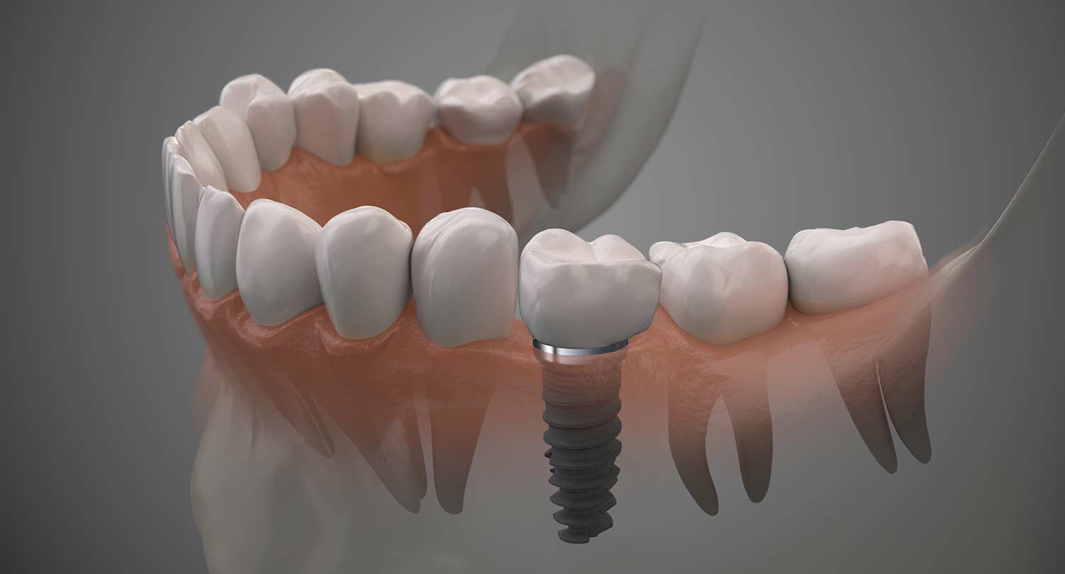 Implant denture reston va