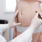 Liposuction (1)