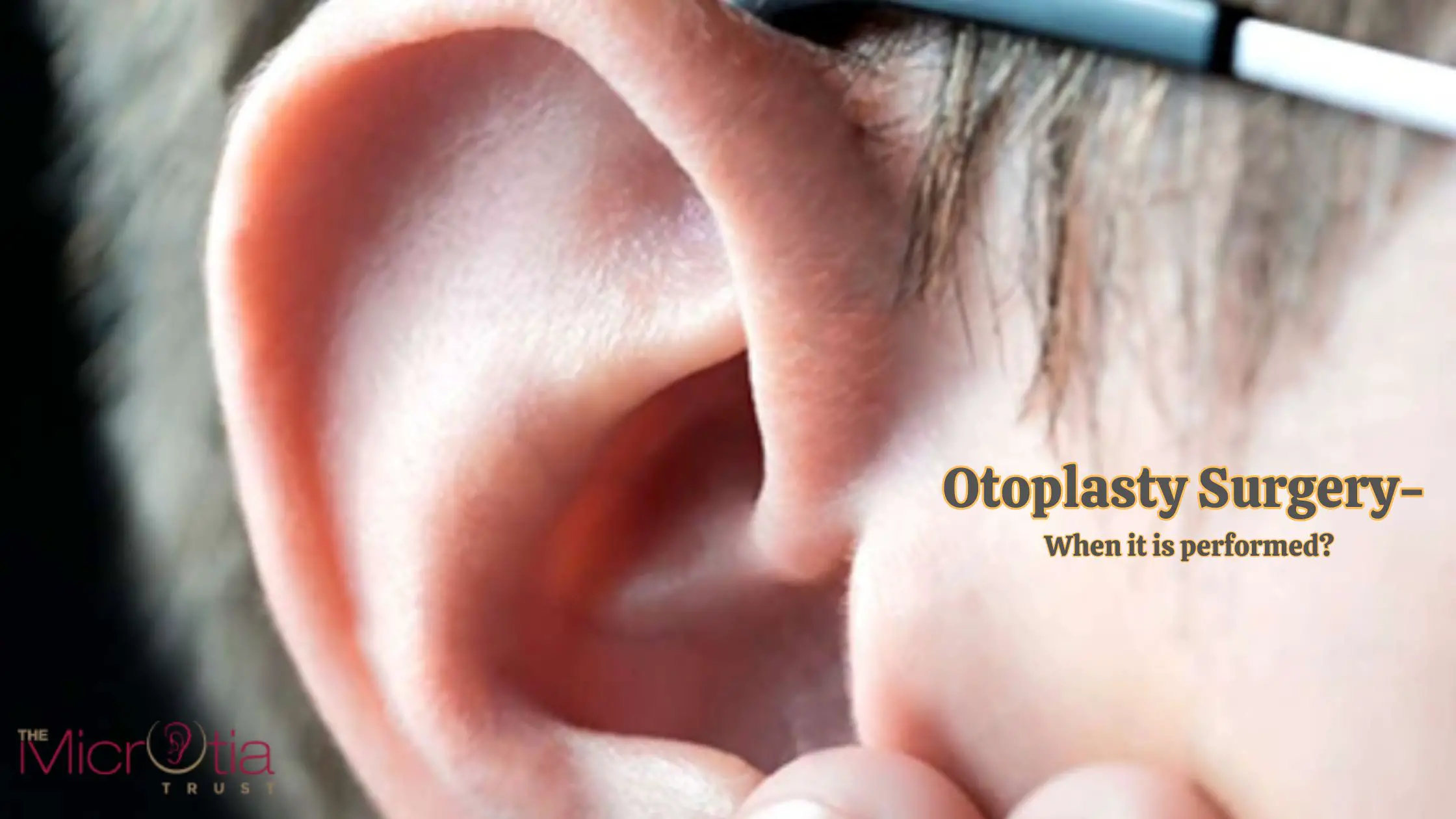 Otoplasty Surgery- When it is performed