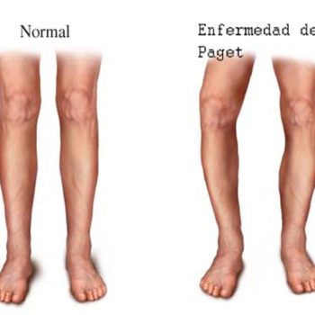 Paget's Disease 01