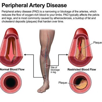 Peripheral Artery Disease