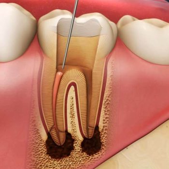 Root-Canal-1