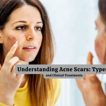 Understanding Acne Scars Types, and Clinical Treatments