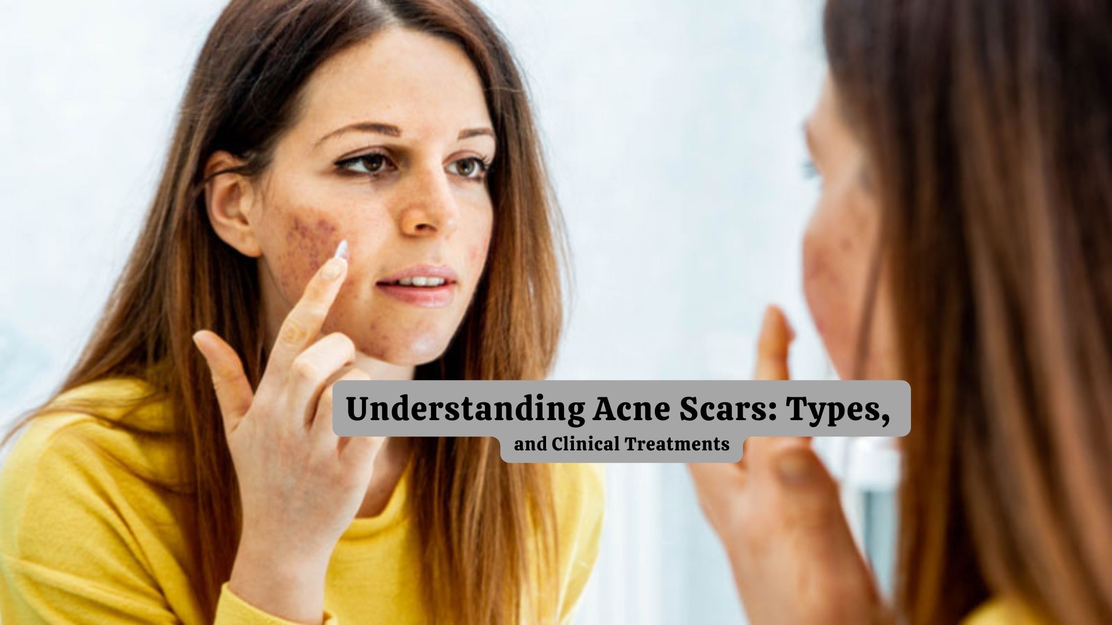 Understanding Acne Scars Types, and Clinical Treatments