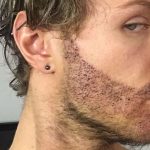 beard hair transplant