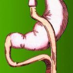 gastric bypass riyadh