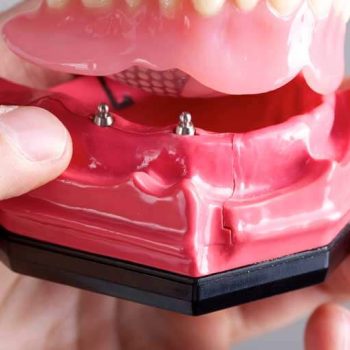 mini implant dentures thibodaux la