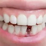 single tooth implant tallahassee fl