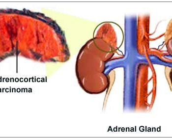 Adrenocortical Carcinoma 01