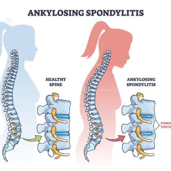 Ankylosing_Spondylitis Disease