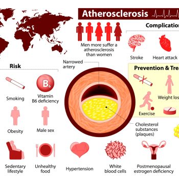 Arteriosclerosis