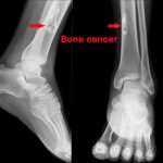 Bone Cancer 01