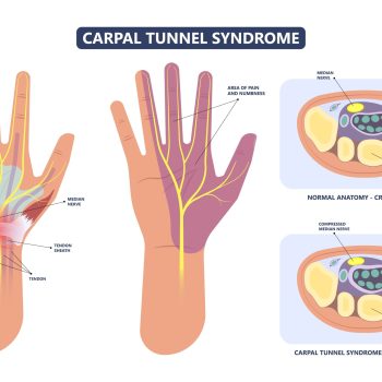Carpal Tunnel Syndrome Disease