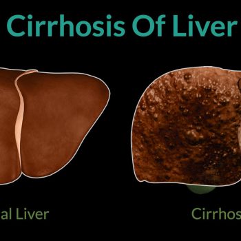 Cirrhosis Disease