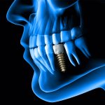 Dental-Implant