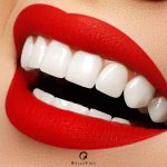Dental-Veneer-Dubai-UAE