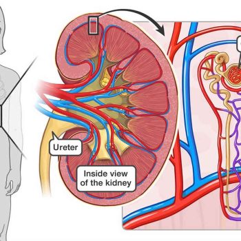 Glomerulonephritis Disease 01