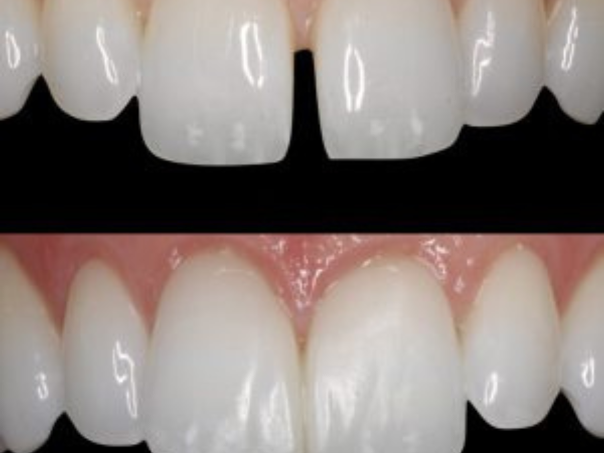 How to correct teeth gaps