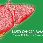 Liver Cancer 01