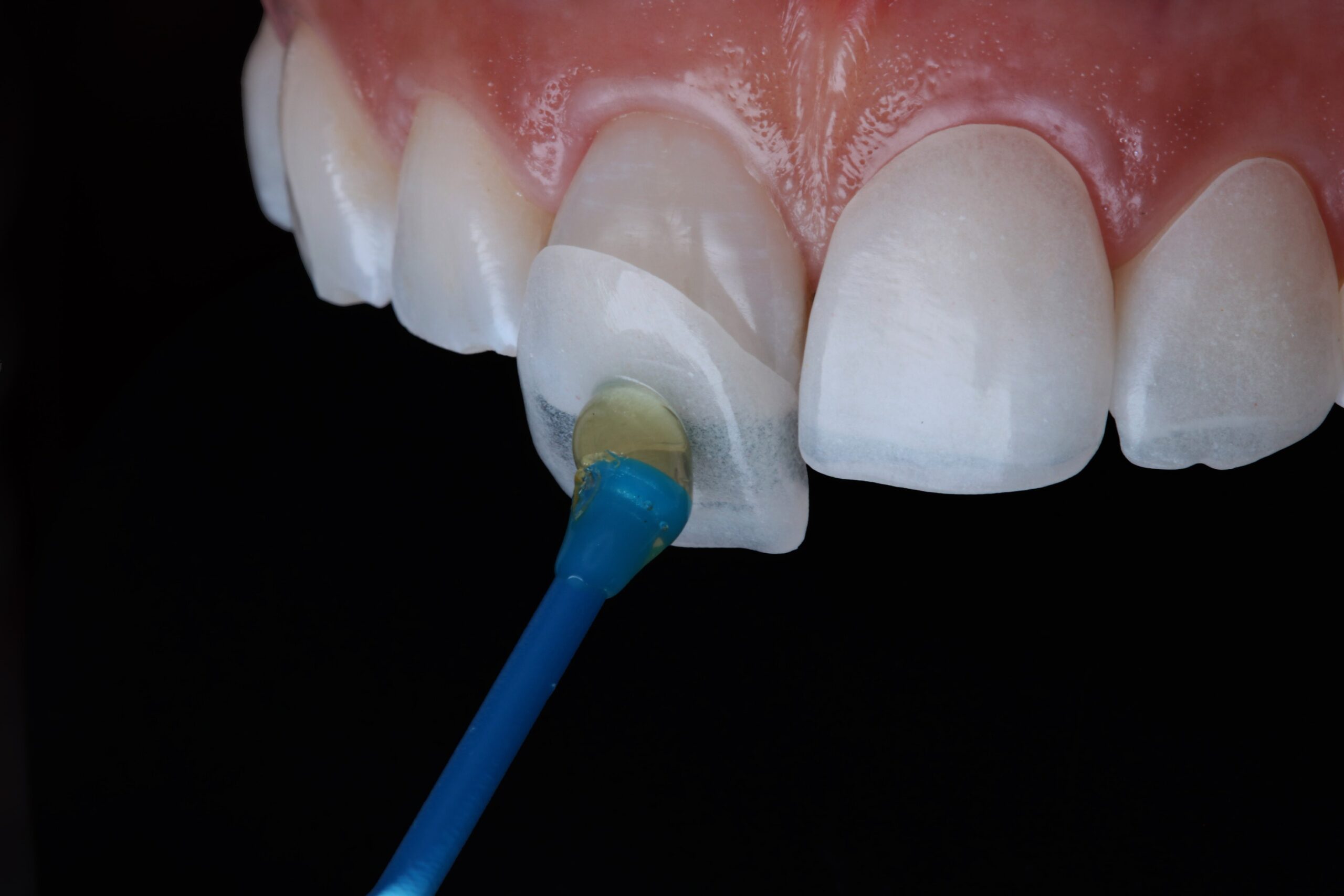 What Happens to Your Teeth Under Veneers