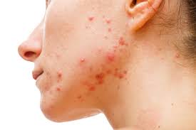 pimples treatment 6