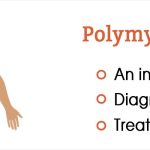 polymyalgia-rheumatica