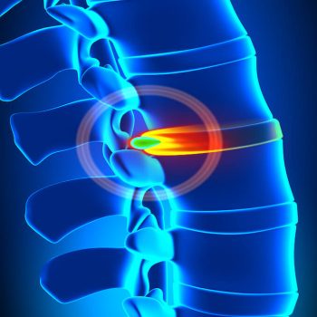 7 Facts About Herniated Discs