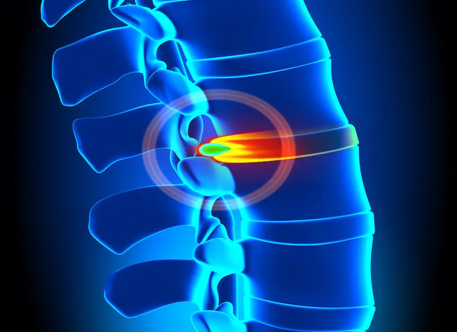 7 Facts About Herniated Discs