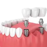 Cheapest-Dental-Implants-in-Abu-Dhabi-Al-Ain-Implants-Cost