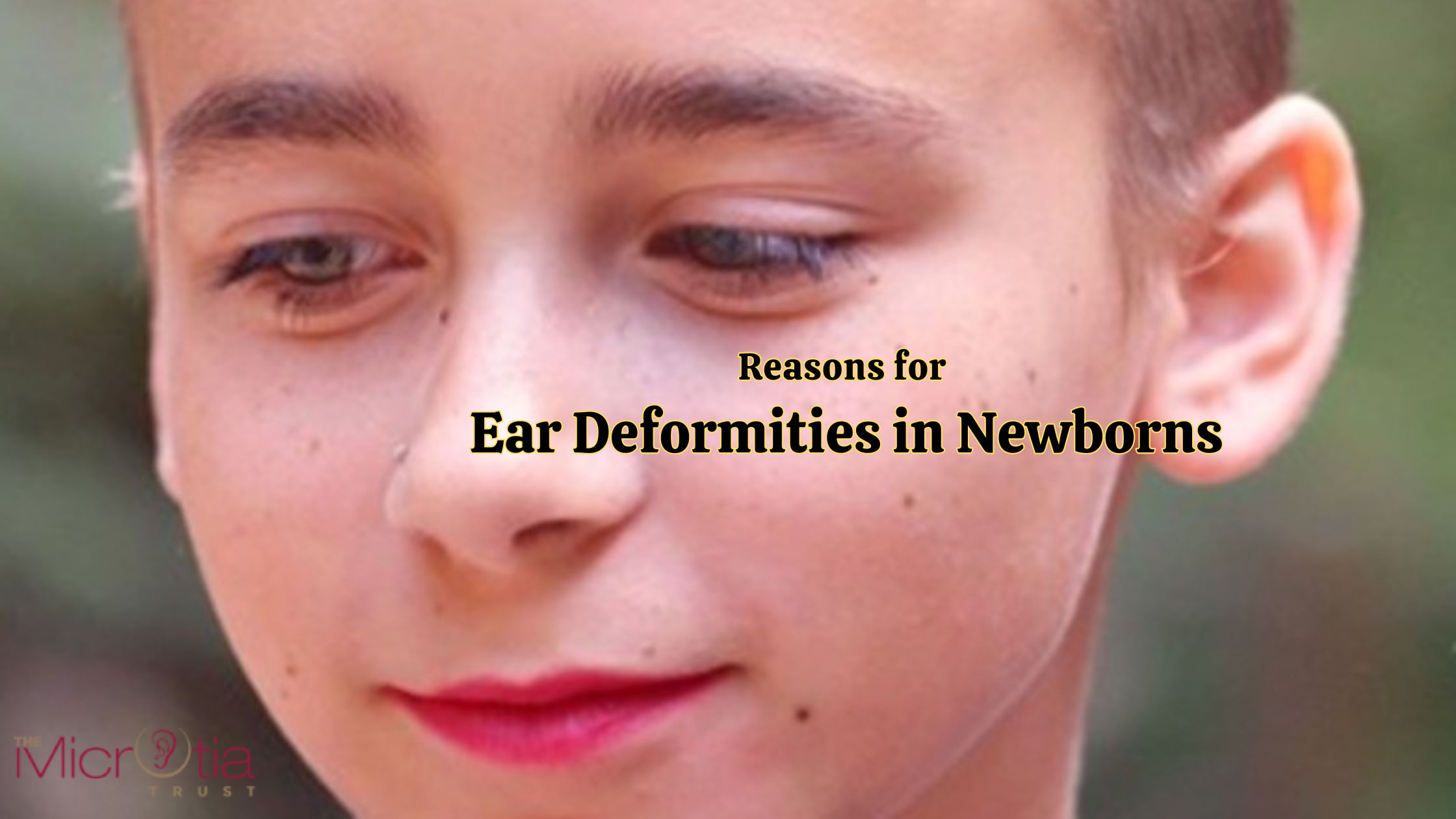 Reasons for Ear Deformities in Newborns