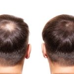 hair transplant