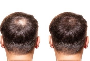 hair transplant