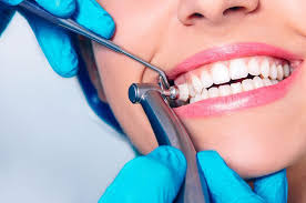 teeth cleaning fort lauderdale