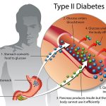 type-2-diabetes-49a3ee