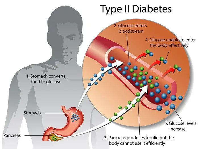 type-2-diabetes-49a3ee